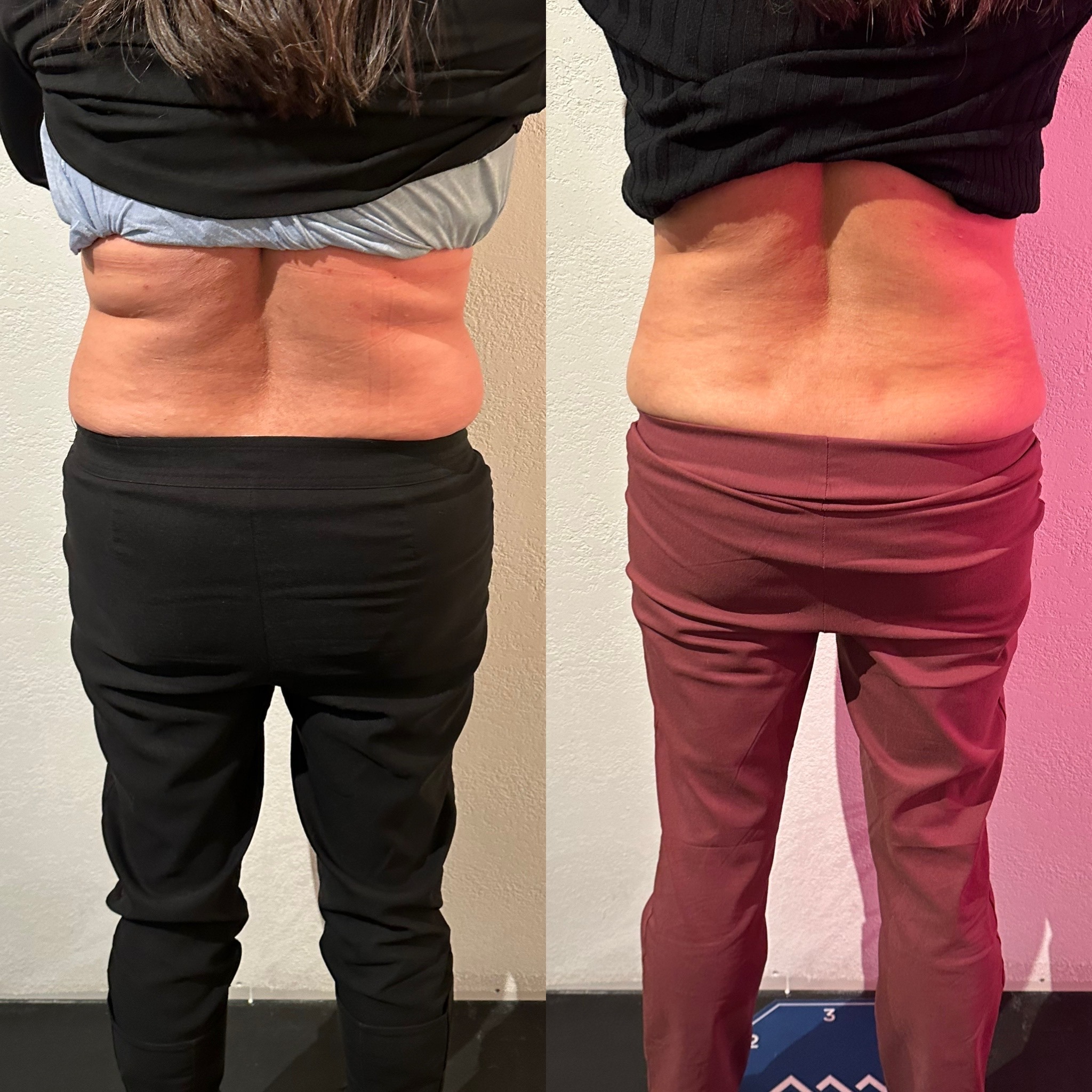 Emsculpt NEO Edge Before and After